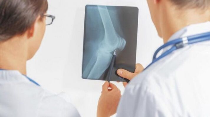 Nach der notwendigen Diagnose einer Arthrose des Kniegelenks verschreiben Ärzte eine komplexe Behandlung