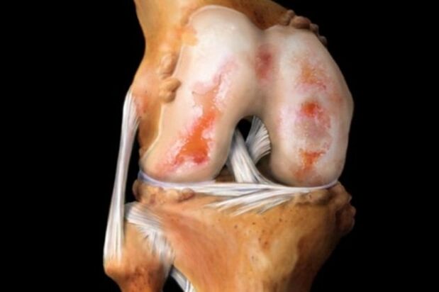 Zerstörung des Kniegelenks durch Arthrose – eine häufige Pathologie des Bewegungsapparates