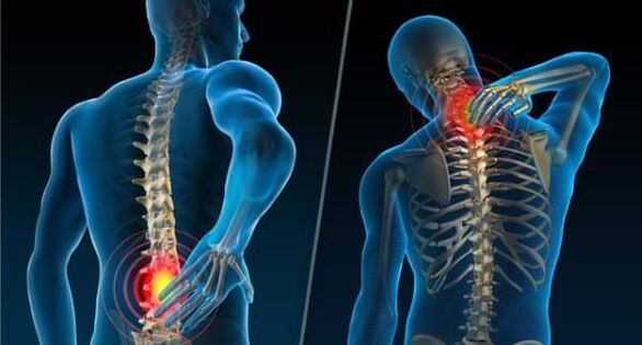 Anzeichen für die Entwicklung einer Osteochondrose sind Schmerzen im Nacken und im unteren Rückenbereich