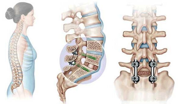 Fixierung verlagerter Wirbel mit Implantaten im fortgeschrittenen Stadium der Osteochondrose