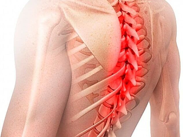 Osteochondrose der Brustwirbelsäule ist eine seltene Form der Erkrankung