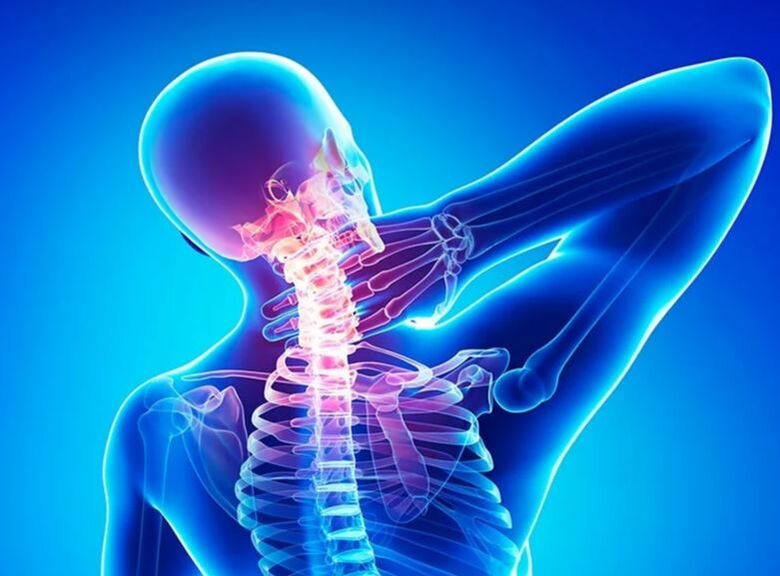Osteochondrose der Halswirbelsäule