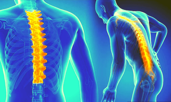 Osteochondrose der Wirbelsäule