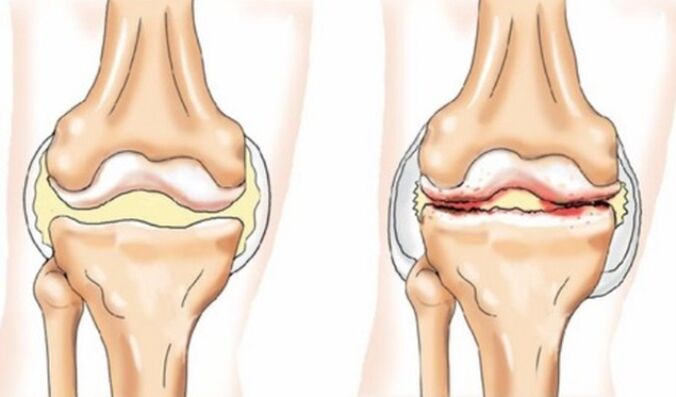 Unterschiede in Arthritis und Arthrose