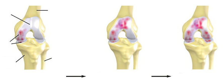 Arthrosestadien
