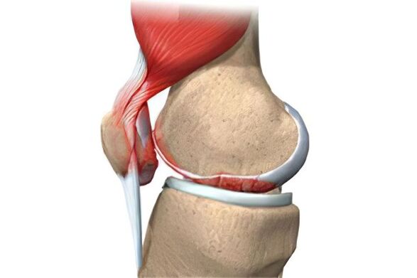 Komplikationen der Arthrose