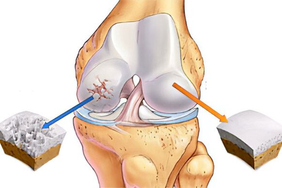 Was ist Arthrose