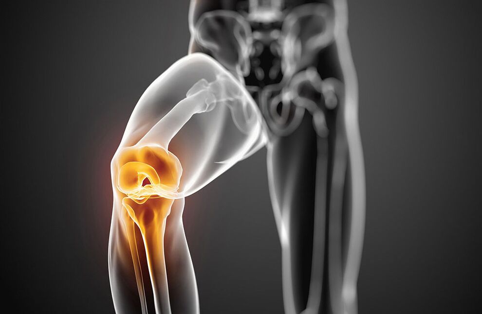 Arthrose des Kniegelenks