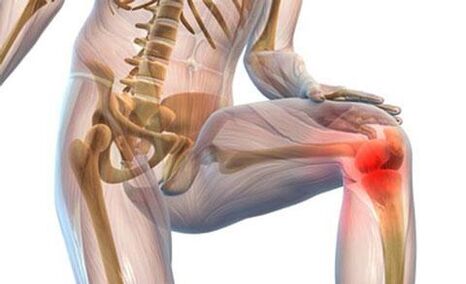 Arthrose des Kniegelenks