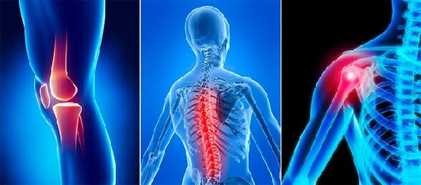 Gelenkschmerzen in der Arthrose