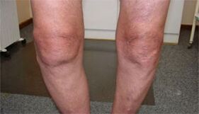 Symptome einer Arthrose