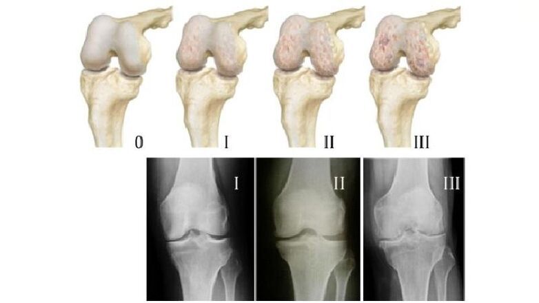 Stadien der Arthrose des Kniegelenks im Röntgenbild