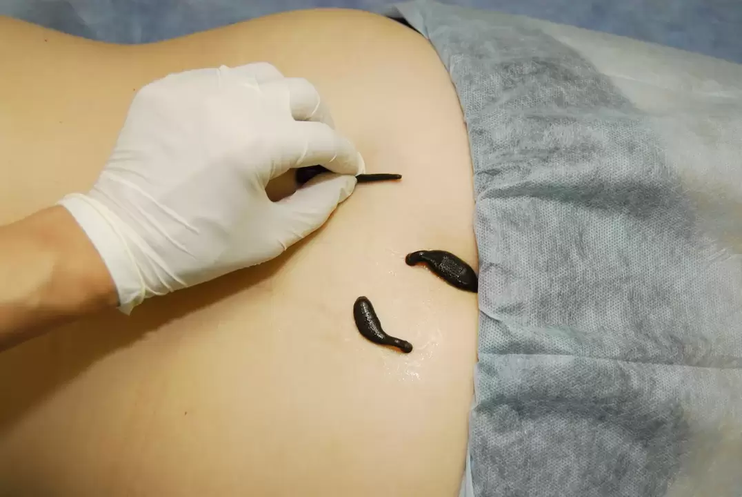 Platzierung von Blutegeln bei lumbaler Osteochondrose