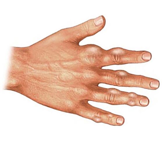 Ablagerung von Harnsäurekristallen in den Weichteilen der Finger bei Gichtarthritis