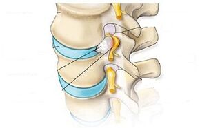 Hauptsymptome der zervikalen Osteochondrose