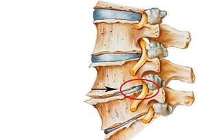 Ursachen der zervikalen Osteochondrose