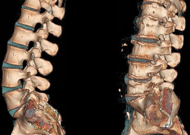 CT-Scan der Lendenwirbelsäule unter normalen Bedingungen und bei Osteochondrose